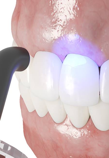 Illustration of composite dental bonding in Lutz, FL
