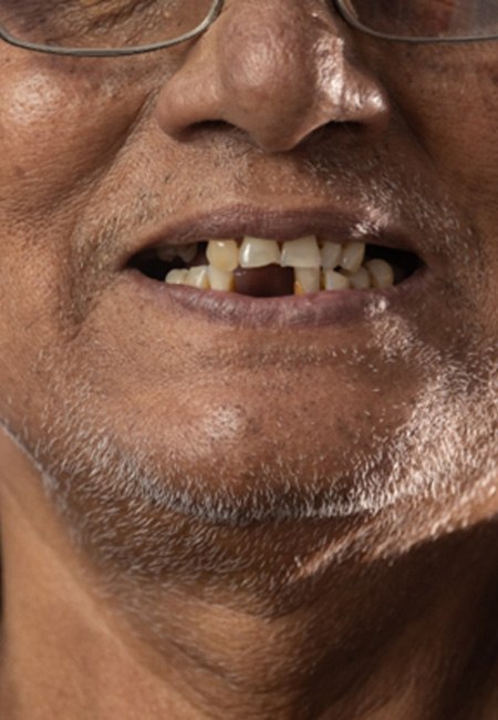 close up on a man’s missing teeth 