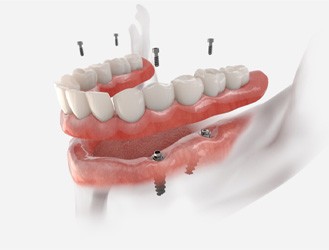diagram of implant dentures 