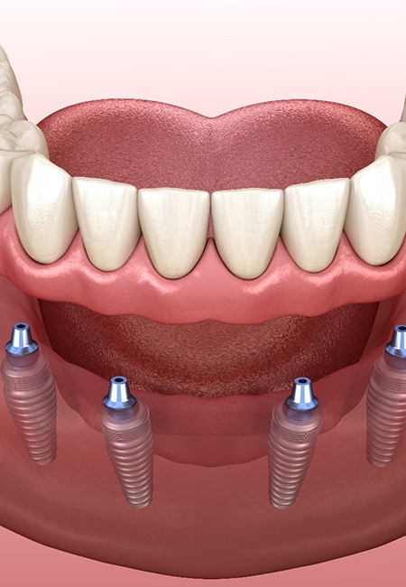 3D render of an implant denture