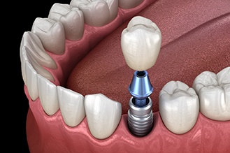 a computer illustration of an implant crown