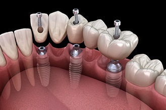 a computer illustration of an implant bridge