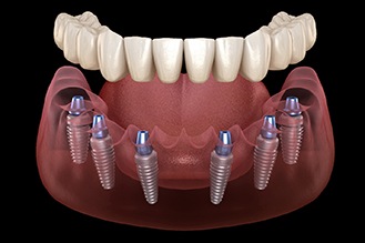 a computer illustration of an implant denture