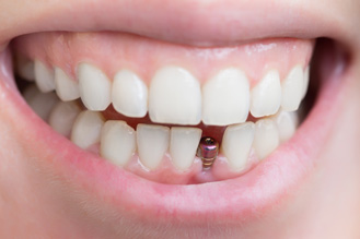 Closeup of a dental implant
