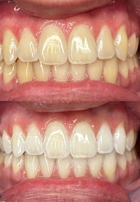 Before and after image of stained and whiter teeth 