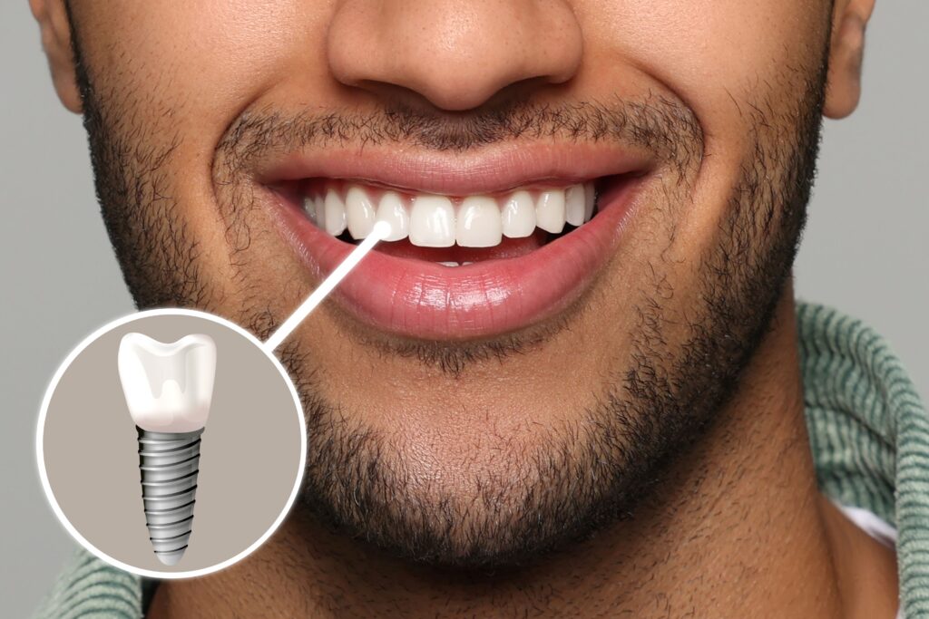 Nose-to-neck view of man smiling with front tooth indicated as an implant