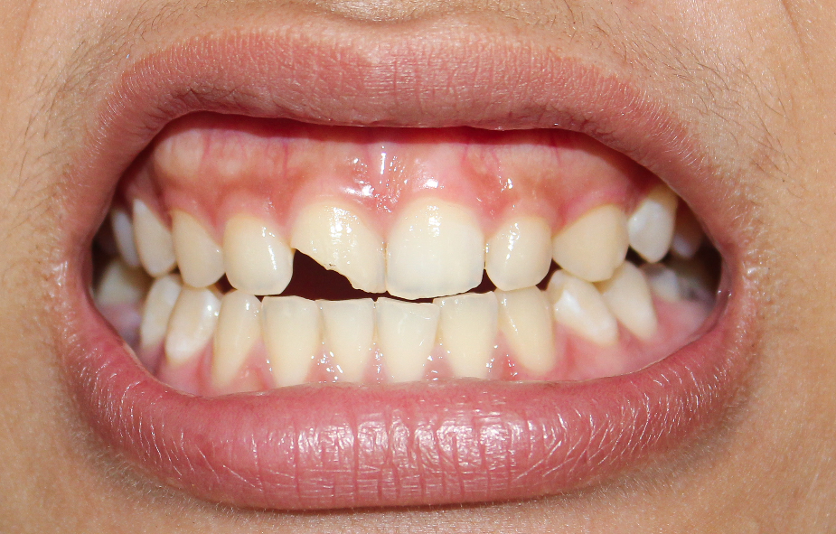 Close up of chipped tooth in mouth